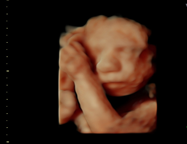 3D ultrasound image at 25 weeks